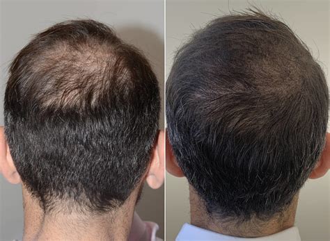 Scalp Micropigmentation in Miami, Florida